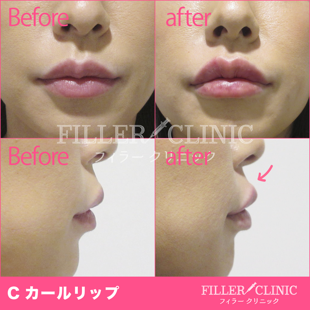 フィラー 口角 唇フィラーの症例です【TAクリニック公式整形ブログ】画像･値段｜美容整形･美容外科