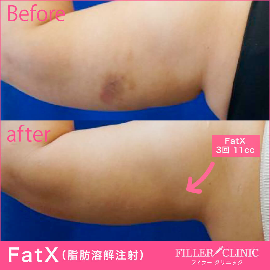 FatX注射：二の腕