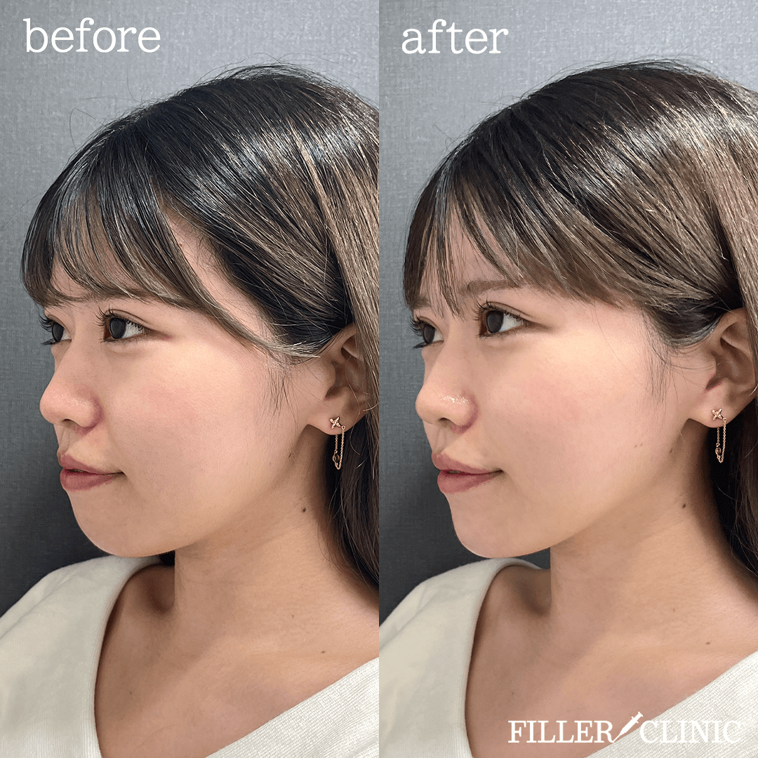 涙袋ヒアルロン酸 症例写真