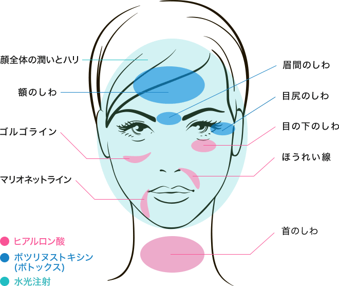 ヒアルロン酸、ボツリヌストキシン、水光注射の注入場所