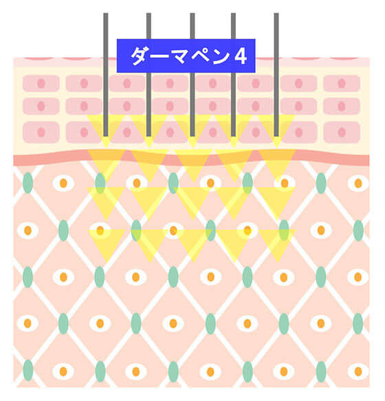 ダーマペン４のメカニズム1