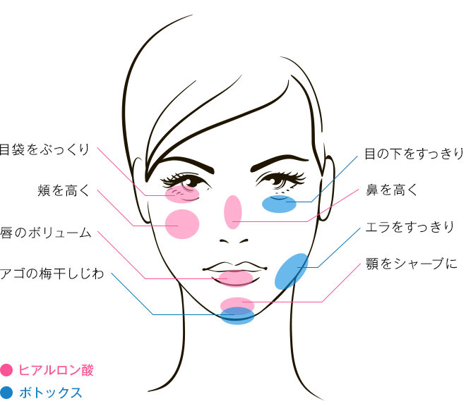 プチ整形 施術箇所と効果イメージ