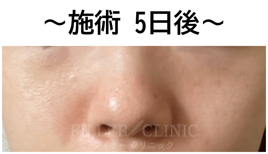 施術 5日後